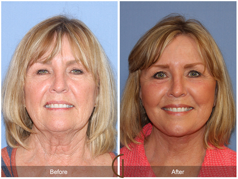 Dr. Kevin Sadati Releases Tip Sheet on Facelift vs. Neck Lift: When A